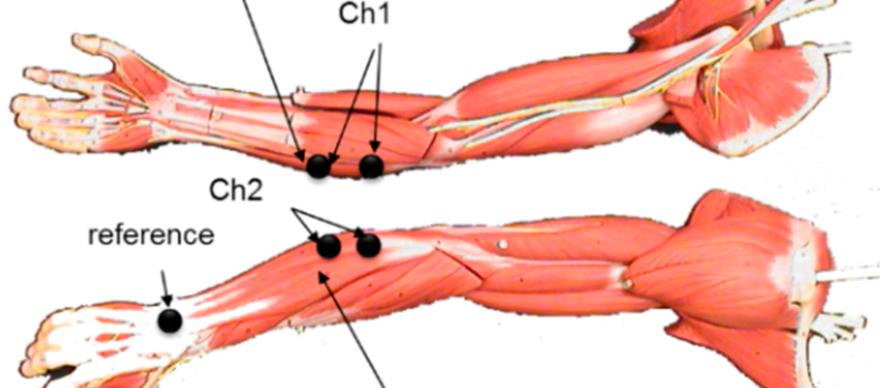 flexor carpi ulnaris