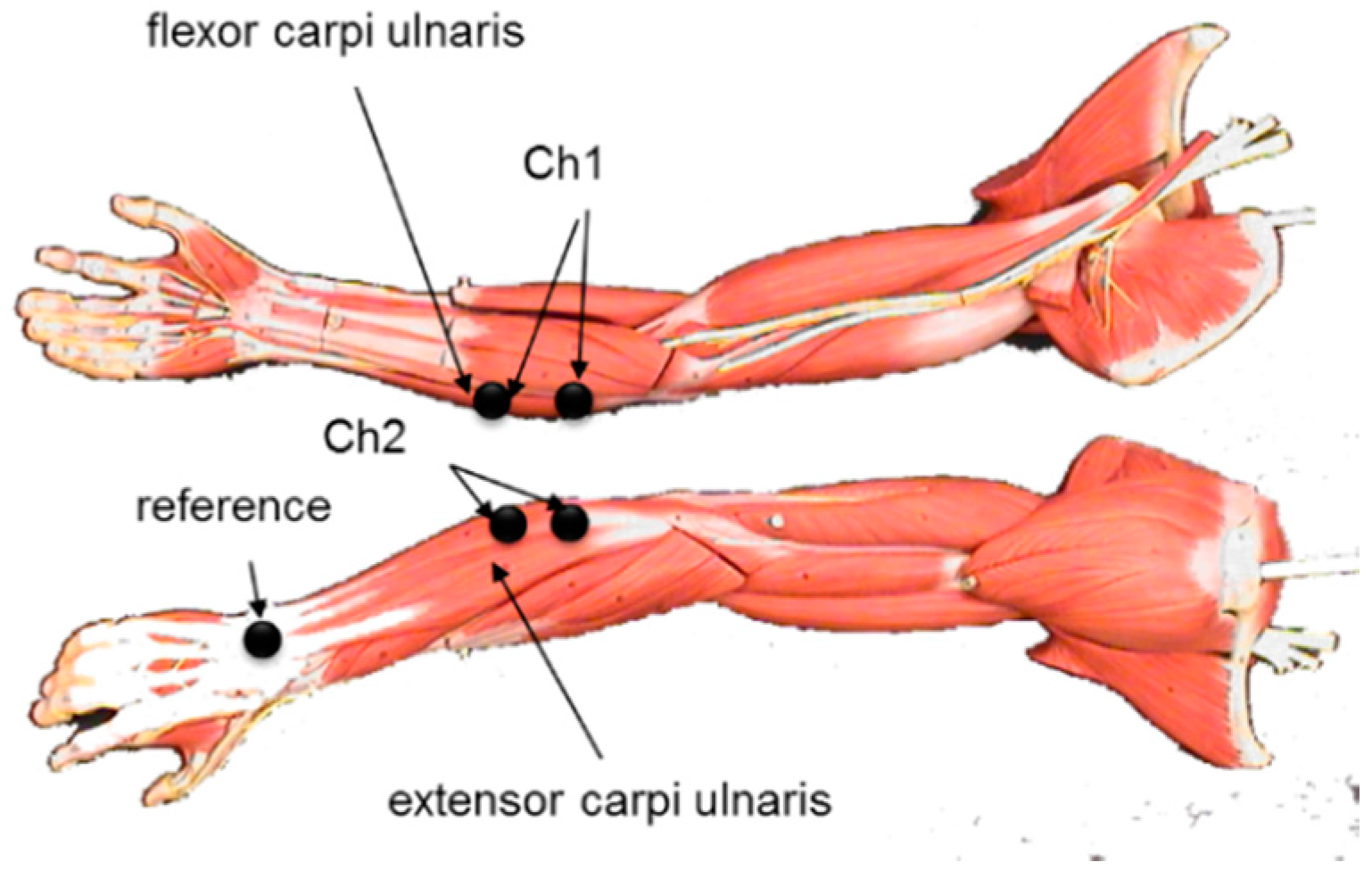 flexor carpi ulnaris