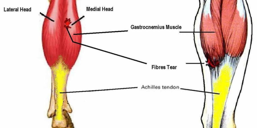 medial head of the gastrocnemius
