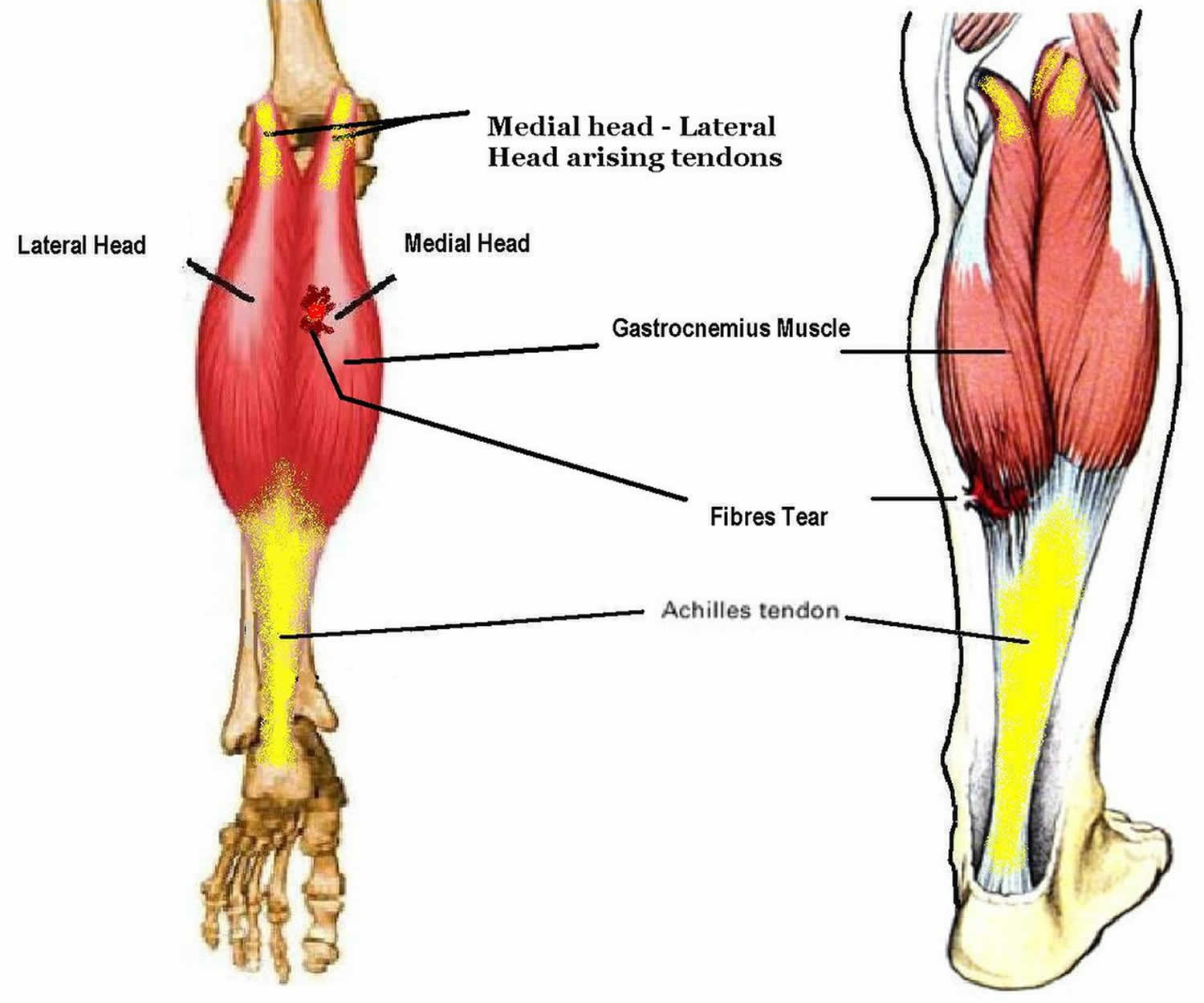 medial head of the gastrocnemius