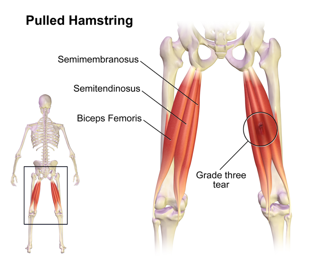 semimembranosus of the hamstrings