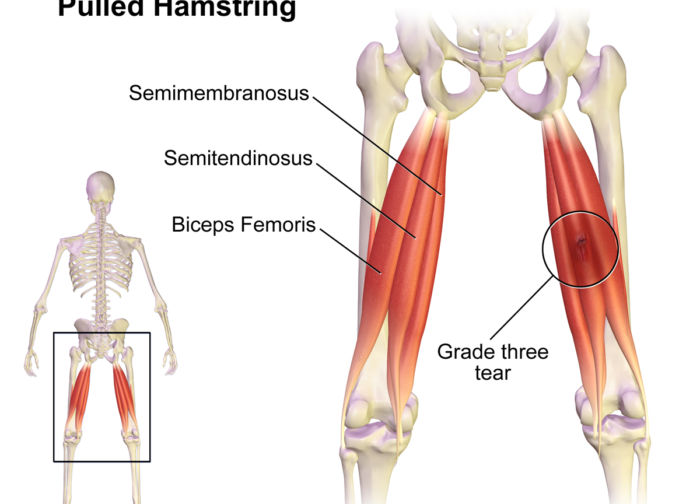semimembranosus of the hamstrings