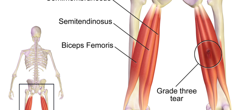 semimembranosus of the hamstrings
